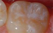 Sealant-After - Pediatric Dentist in Greer, SC